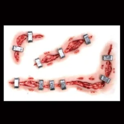 Tinsley Transfers Staplestein Prosthetics